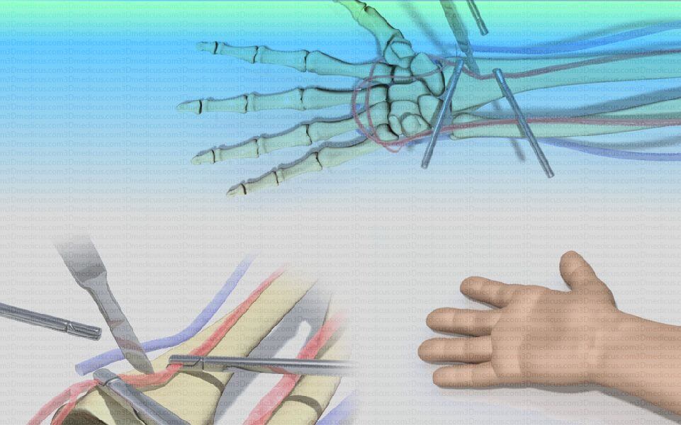 Achievements Arteriovenous Fistula